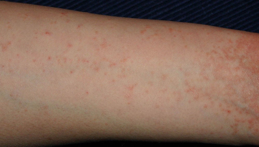 Brazo con dermatitis