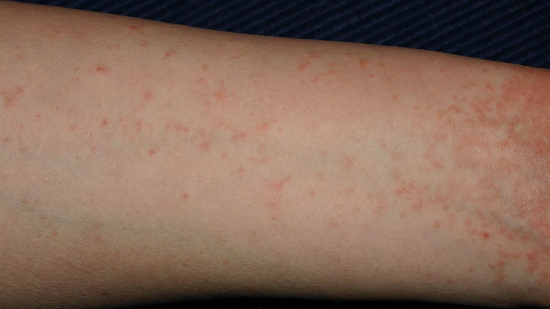 Brazo con dermatitis Brazo con dermatitis