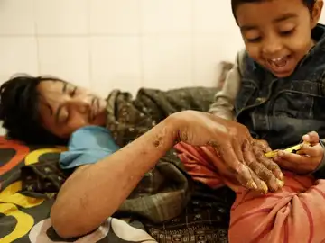 Abul Bajandar, conocido como 'hombre árbol', juega con su hija Abul Bajandar, conocido como 'hombre árbol', juega con su hija