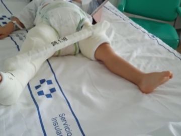 Un niño de dos años que se rompió el femúr en Gran Canaria no puede volver a casa porque el seguro no cubre viajar en camilla