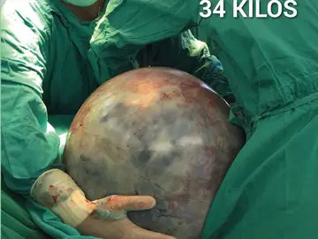 El tumor de 34 kilos El tumor de 34 kilos
