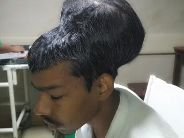 Santlal Pal, el paciente que ha sobrevivido a la extirpación del tumor cerebral más grande Santlal Pal, el paciente que ha sobrevivido a la extirpación del tumor cerebral más grande