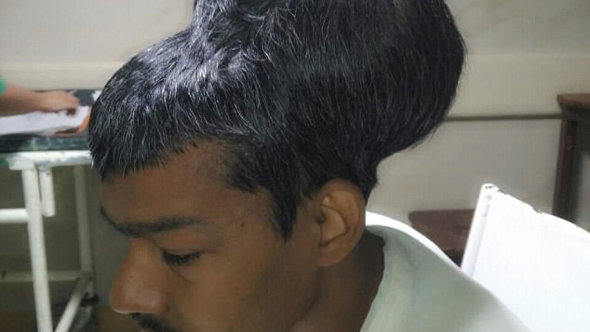 Santlal Pal, el paciente que ha sobrevivido a la extirpación del tumor cerebral más grande Santlal Pal, el paciente que ha sobrevivido a la extirpación del tumor cerebral más grande