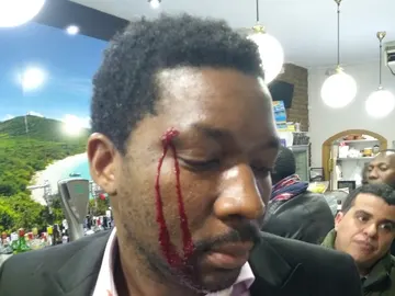 El actor muestra un corte en la ceja tras el ataque racista en Madrid El actor muestra un corte en la ceja tras el ataque racista en Madrid