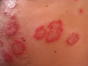 Caso de Psoriasis Caso de Psoriasis