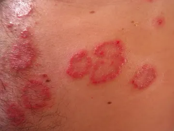 Caso de Psoriasis Caso de Psoriasis