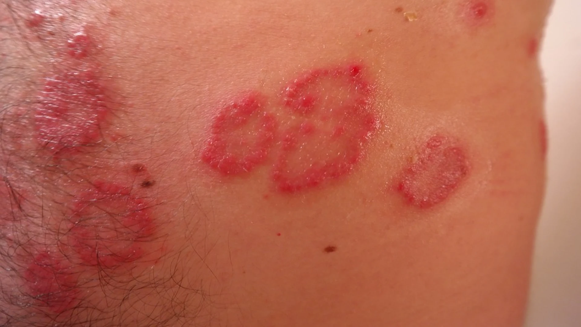Caso de Psoriasis Caso de Psoriasis