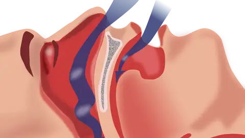 Un sistema portatil para detectar apnea del sueno en pacientes con EPOC Un sistema portatil para detectar apnea del sueno en pacientes con EPOC