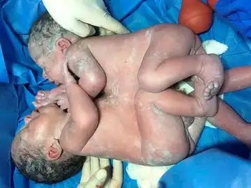 Separan a unos siameses mexicanos unidos por el tórax y el abdomen Separan a unos siameses mexicanos unidos por el tórax y el abdomen