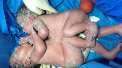 Separan con éxito a unos siameses unidos por el tórax y el abdomen en México