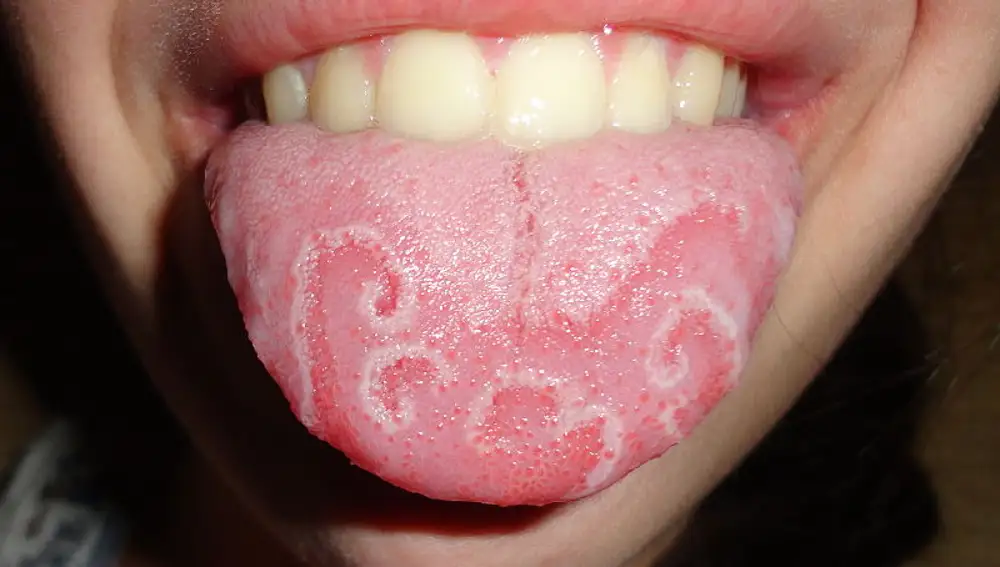 Las manchas blancas en la lengua deben vigilarse.