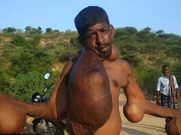 El hombre con cinco tumores gigantes El hombre con cinco tumores gigantes