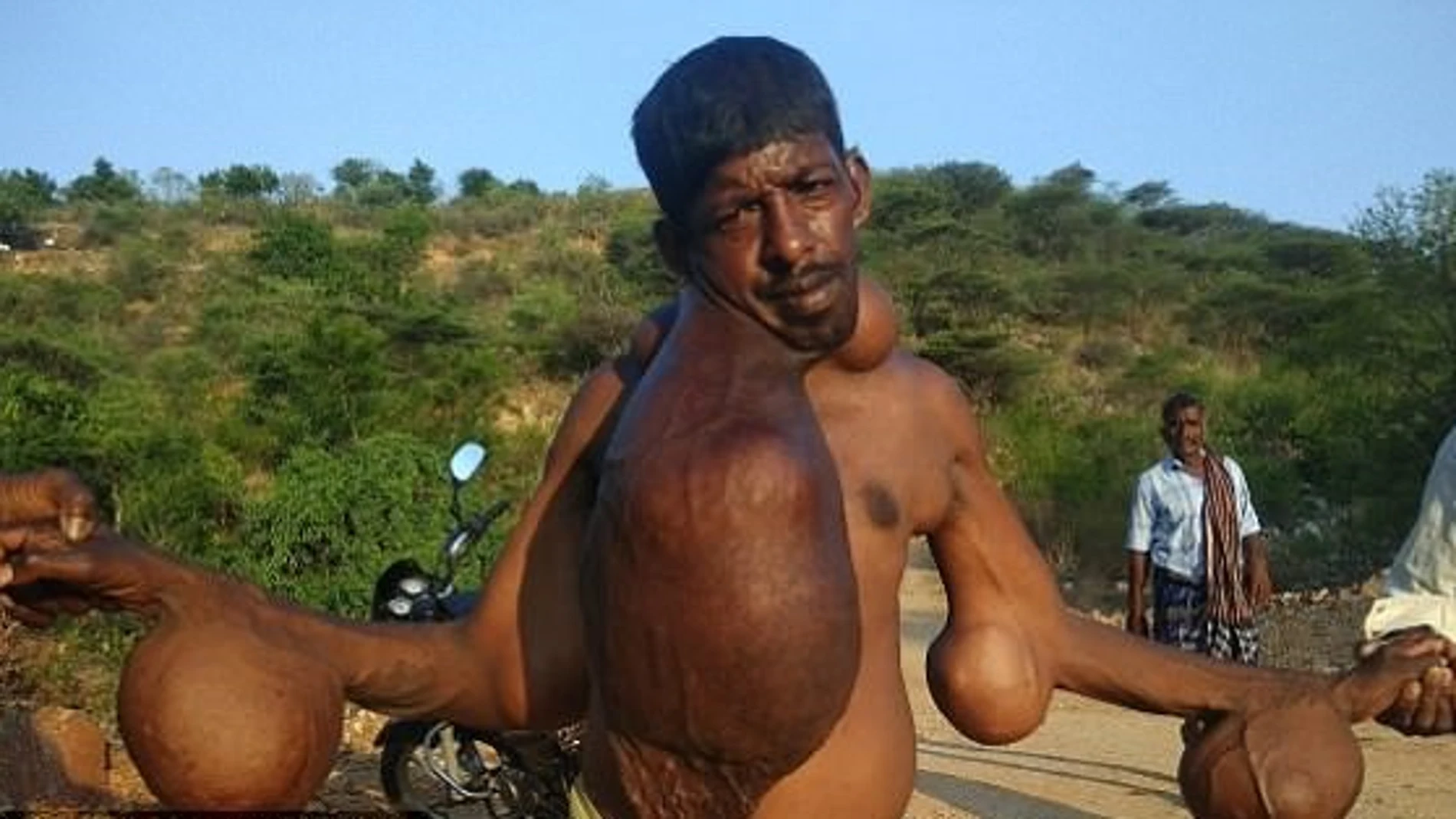 El hombre con cinco tumores gigantes El hombre con cinco tumores gigantes