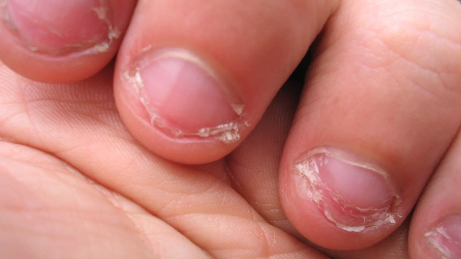 Uñas mordidas Uñas mordidas