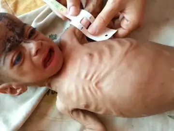 Incremento de la desnutrición infantil en Yemen Incremento de la desnutrición infantil en Yemen