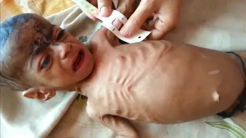 Incremento de la desnutrición infantil en Yemen Incremento de la desnutrición infantil en Yemen