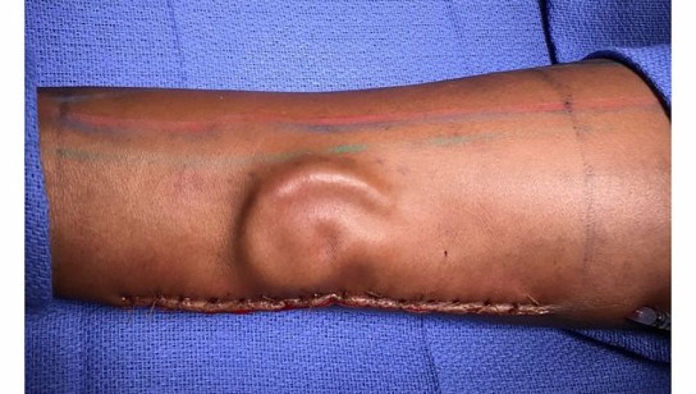 La oreja implantada en el brazo