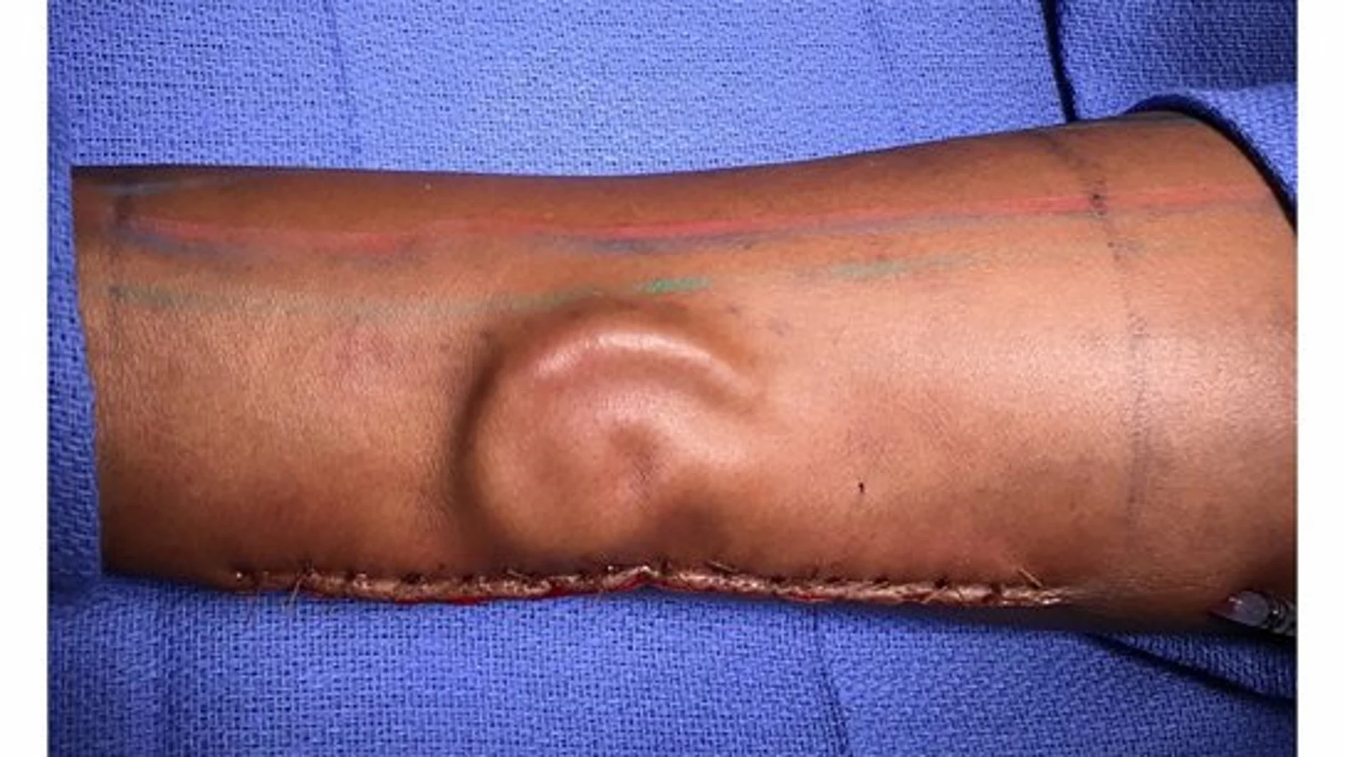 La oreja implantada en el brazo La oreja implantada en el brazo