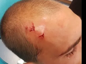 Bas Dost, jugador del Sporting, con una herida en la cabeza Bas Dost, jugador del Sporting, con una herida en la cabeza