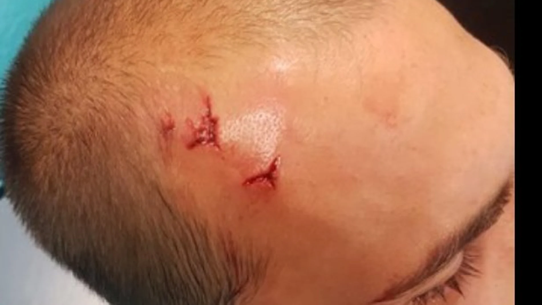 Bas Dost, jugador del Sporting, con una herida en la cabeza Bas Dost, jugador del Sporting, con una herida en la cabeza