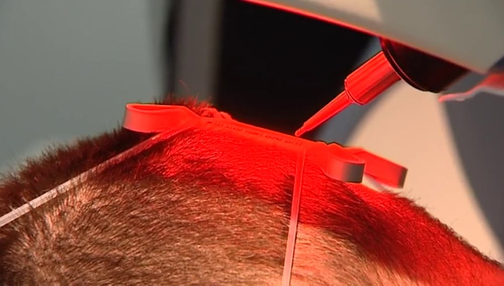 Los riesgos de los implantes de pelo "low cost" en Turquía
