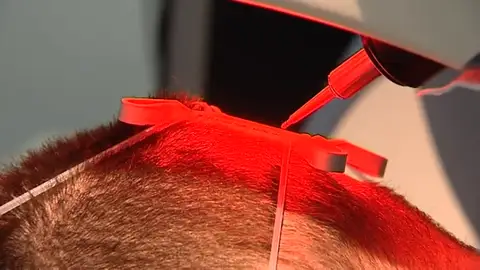 Los riesgos de los implantes de pelo "low cost" en Turquía Los riesgos de los implantes de pelo "low cost" en Turquía