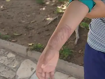 La picadura de una medusa deja a un niño graves lesiones en la piel La picadura de una medusa deja a un niño graves lesiones en la piel