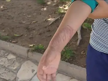 La picadura de una medusa deja a un niño graves lesiones en la piel La picadura de una medusa deja a un niño graves lesiones en la piel