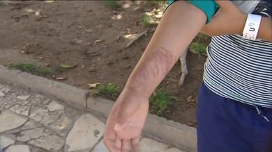 La picadura de una medusa deja a un niño graves lesiones en la piel