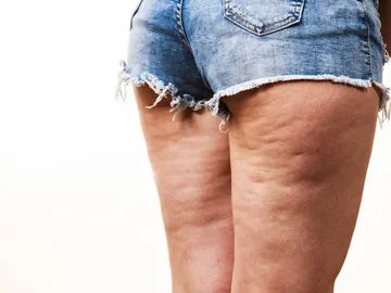 ¿Es posible acabar con la celulitis? ¿Es posible acabar con la celulitis?