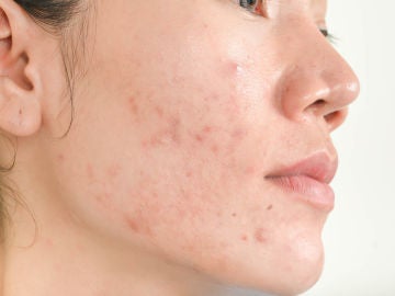 Tratamientos caseros para pieles con acné