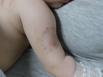 Imagen de los hematomas del bebé Imagen de los hematomas del bebé