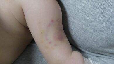 Detienen a los padres de un bebé que presentaba lesiones compatibles con mordeduras en Mallorca