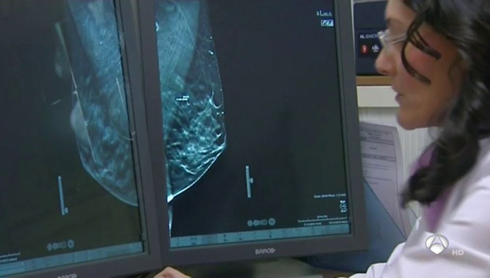 Mamografía, técnica diagnóstica de cáncer de mama