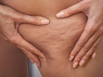 Cómo combatir la celulitis Cómo combatir la celulitis