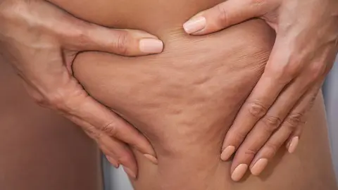 Cómo combatir la celulitis Infusiones