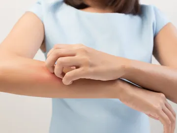Quemadura en un brazo Quemadura en un brazo