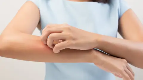 Quemadura en un brazo