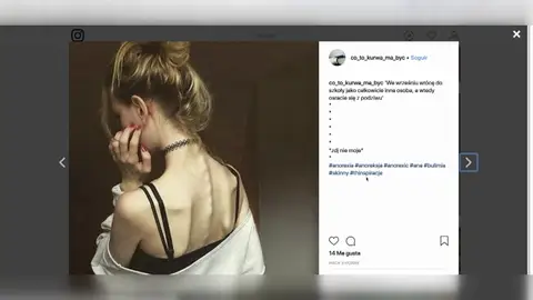 Las redes sociales hacen que aumente el número de casos de anorexia Las redes sociales hacen que aumente el número de casos de anorexia