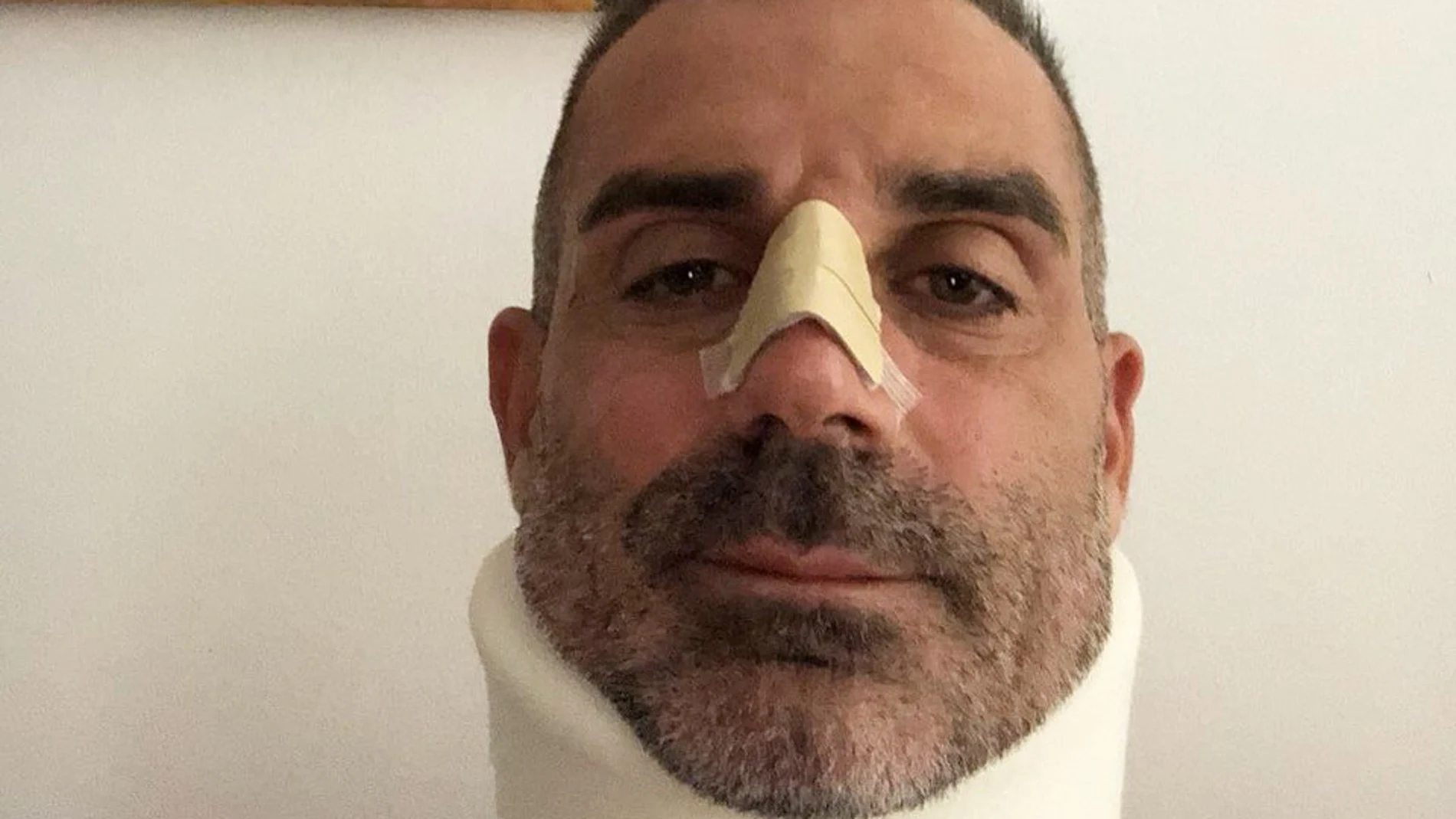 Sorrentino, con la nariz rota Sorrentino, con la nariz rota