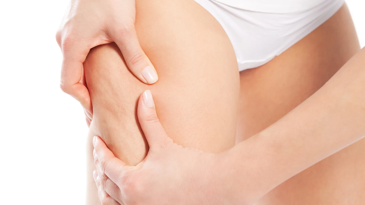 Celulitis Celulitis