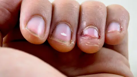 Uñas mordidas Uñas mordidas
