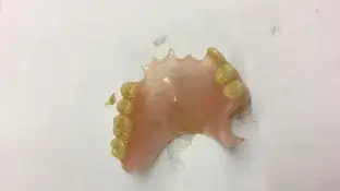 Dentadura postiza Dentadura postiza