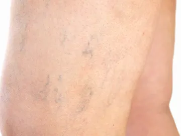 Varices en las piernas Varices en las piernas
