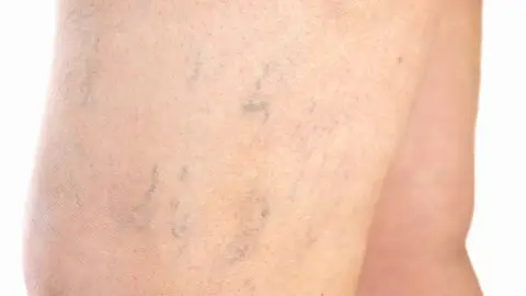 Varices en las piernas Varices en las piernas