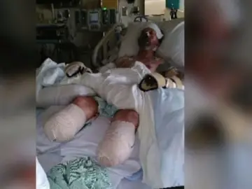Greg Manteufel, el hombre al que le amputaron sus extremidades por una bacteria contagiada con la saliva de su perro Greg Manteufel, el hombre al que le amputaron sus extremidades por una bacteria contagiada con la saliva de su perro