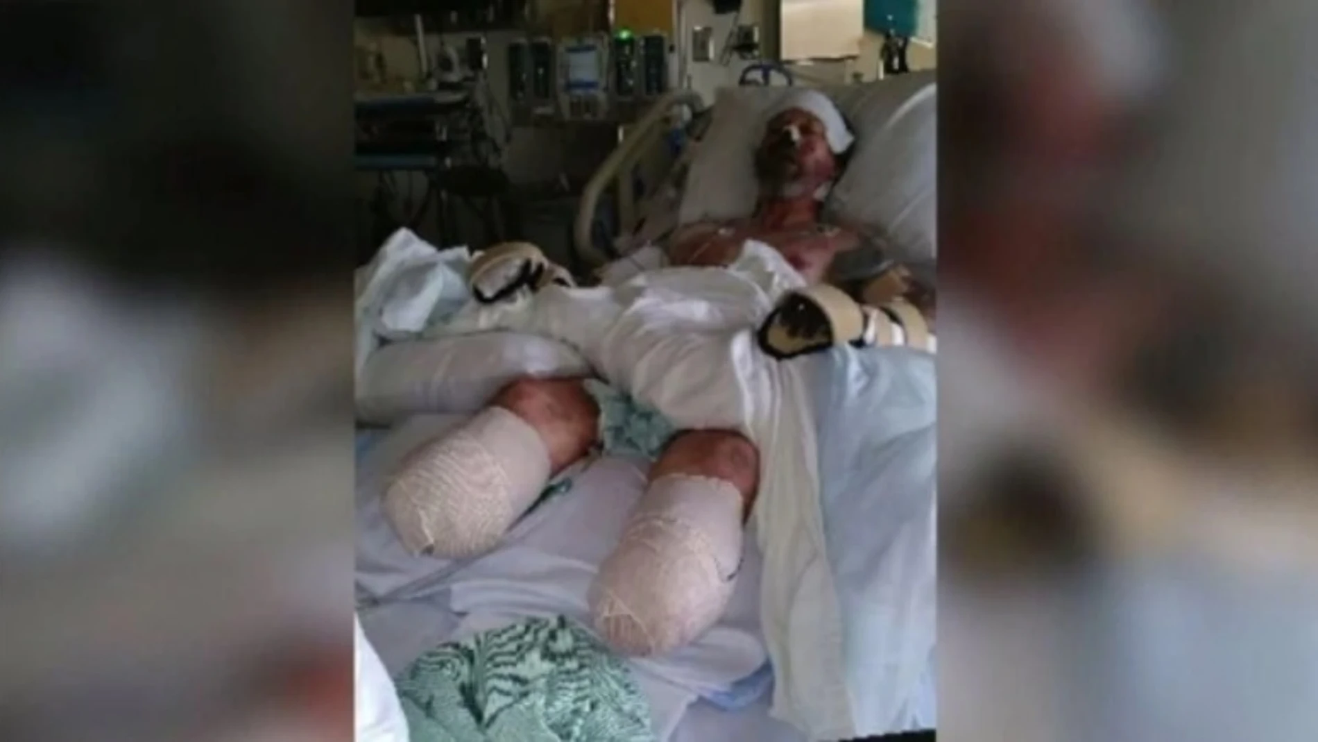 Greg Manteufel, el hombre al que le amputaron sus extremidades por una bacteria contagiada con la saliva de su perro Greg Manteufel, el hombre al que le amputaron sus extremidades por una bacteria contagiada con la saliva de su perro