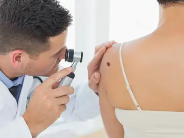 Prevención de melanoma Prevención de melanoma