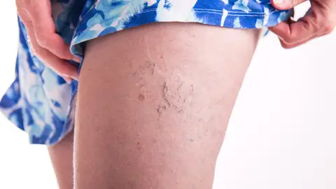 Varices Varices