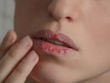 Mujer con los labios secos y agrietados Mujer con los labios secos y agrietados